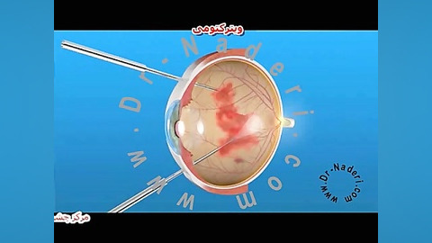 عمل ویترکتومی -مرکزچشم پزشکی دکتر علیرضا نادری مرکز چشم پزشکی دکتر علیرضا نادری www.dr-naderi.com
