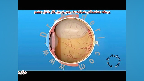 عمل ویترکتومی با تزریق گاز-مرکزچشم دکترعلیرضانادری مرکز چشم پزشکی دکتر علیرضا نادری www.dr-naderi.com