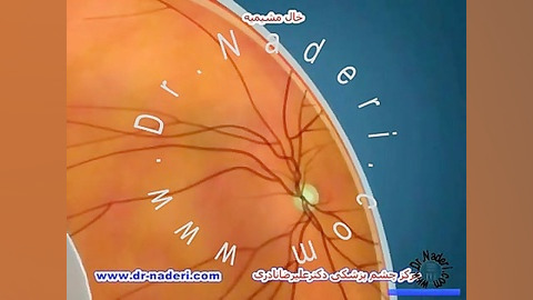 خال مشیمیه (کوروئید)- مرکزچشم پزشکی دکتر علیرضا نادری مرکز چشم پزشکی دکتر علیرضا نادری www.dr-naderi.com