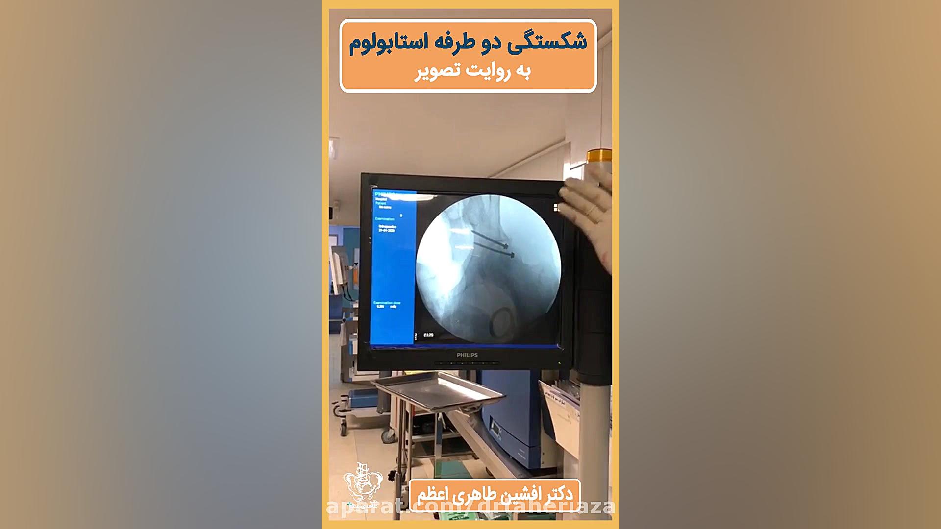 شکستگی دوطرفه استابولوم شادمهر عقیلی