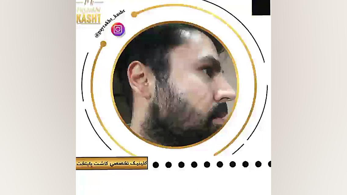 کاشت ریش طبیعی | کلینیک آیتک | 44221324-021 پر کردن دندان