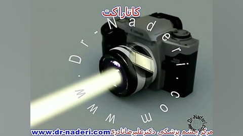 کاتاراکت یاآب مروارید-سایت چشم پزشکی دکتر علیرضا ناد ری مرکز چشم پزشکی دکتر علیرضا نادری www.dr-naderi.com