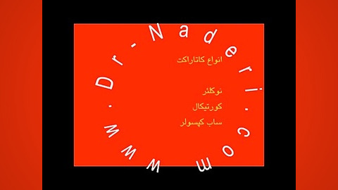 انواع کاتاراکت یا آب مروارید- مرکز چشم پزشکی دکتر نادری مرکز چشم پزشکی دکتر علیرضا نادری www.dr-naderi.com