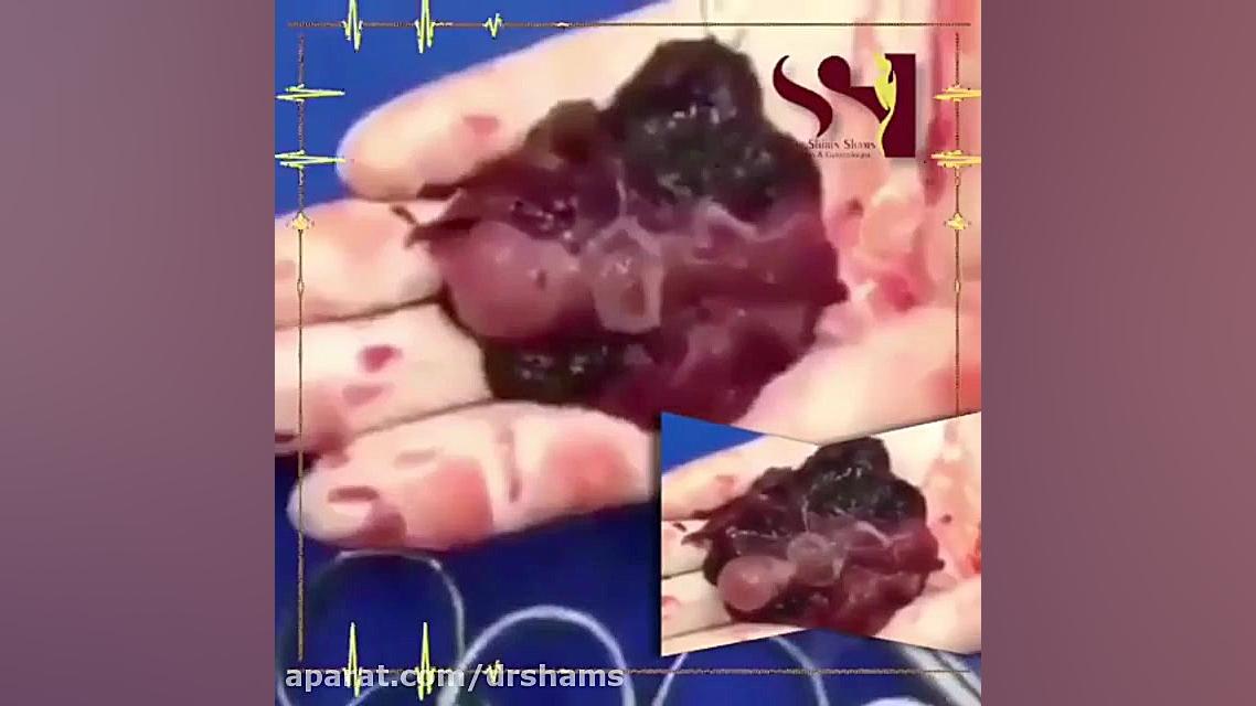 حرکت دست و پای جنین امیر جدیدی