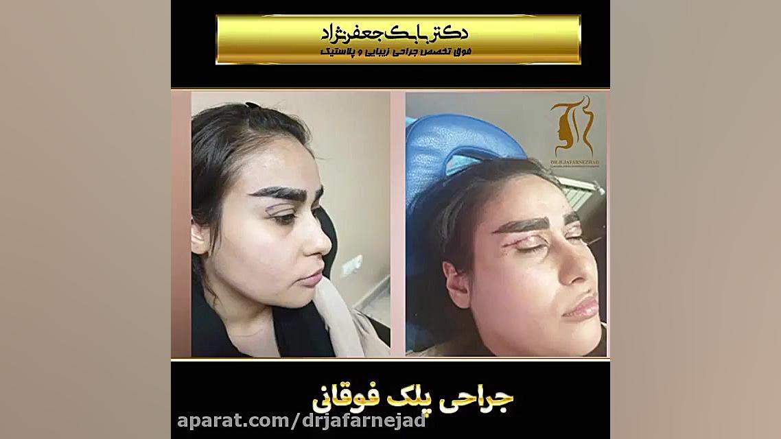 جراحی پلک فوقانی دکتر بابک جعفرنژاد