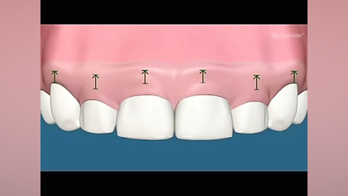 گامی اسمایل Gummy smil دکتر سهیل سالاری