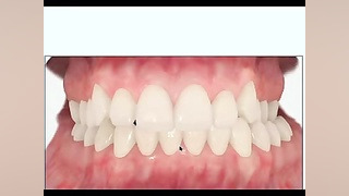 کراس بایت (cross bite) دکتر سهیل سالاری