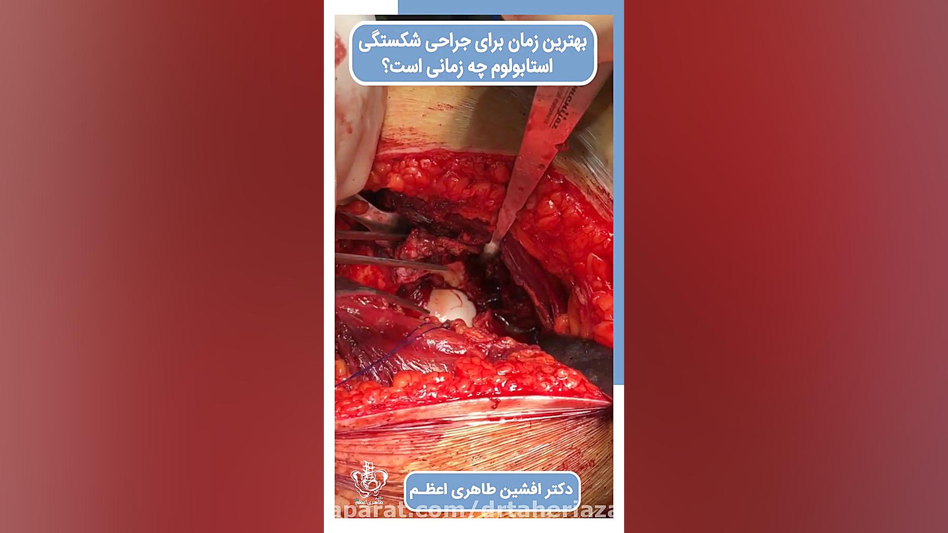 بهترین زمان درمان شکستگی استابولوم رفع افتادگی پلک