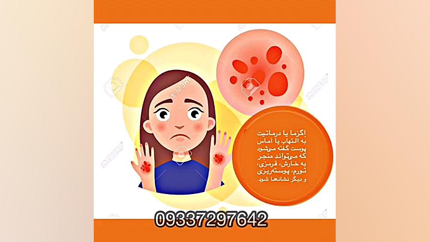 نمونه درمان شده بیماری اگزما گل گدوت