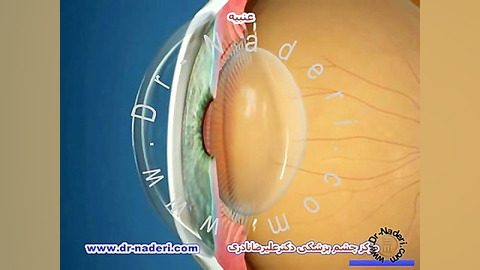 عنبیه یا ایریس - مرکز چشم پزشکی دکتر علیرضا نادری مرکز چشم پزشکی دکتر علیرضا نادری www.dr-naderi.com