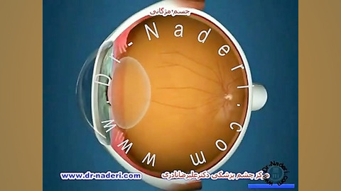 جسم مژگانی - مرکز چشم پزشکی دکتر علیرضا نادری مرکز چشم پزشکی دکتر علیرضا نادری www.dr-naderi.com