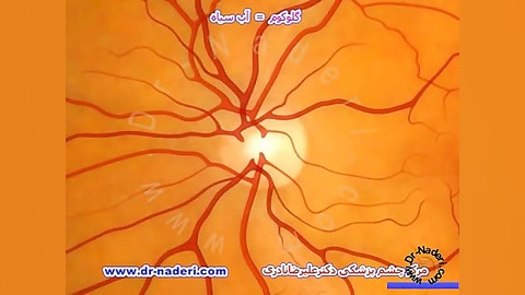 گلوکوم یاآب سیاه چیست؟ مرکز چشم پزشکی دکتر علیر ضانادری مرکز چشم پزشکی دکتر علیرضا نادری www.dr-naderi.com