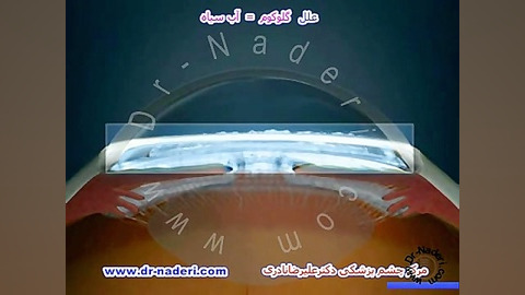علل گلوکوم یا آب سیاه- مرکز چشم پزشکی دکتر علیرضا نادری لیزر موهای زائد
