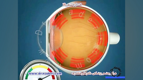فشار چشم بالا - مرکز چشم پزشکی دکتر علیرضا نادری مرکز چشم پزشکی دکتر علیرضا نادری www.dr-naderi.com