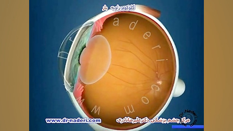گلوکوم با زاویه باز - مرکز چشم پزشکی دکتر علیرضا نادری مرکز چشم پزشکی دکتر علیرضا نادری www.dr-naderi.com