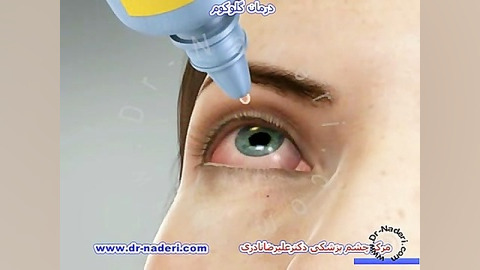 درمان گلوکوم (آب سیاه)-مرکز چشم پزشکی دکتر علیرضا نادری مرکز چشم پزشکی دکتر علیرضا نادری www.dr-naderi.com