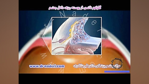 گلوکوم ناشی از پوسته ریزی-مرکز چشم پزشکی دکتر نادری مرکز چشم پزشکی دکتر علیرضا نادری www.dr-naderi.com