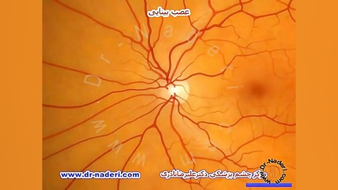 عصب بینایی-ساختمان چشم-مرکز چشم پزشکی دکتر علیرضا نادری مرکز چشم پزشکی دکتر علیرضا نادری www.dr-naderi.com