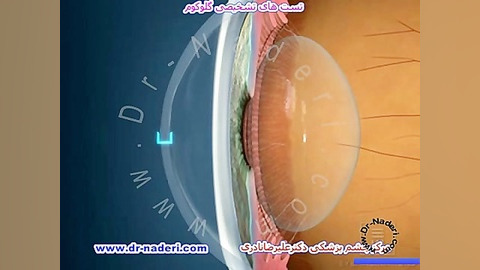 تست های تشخیصی گلوکوم-مرکز چشم پزشکی دکتر علیرضا نادری مرکز چشم پزشکی دکتر علیرضا نادری www.dr-naderi.com