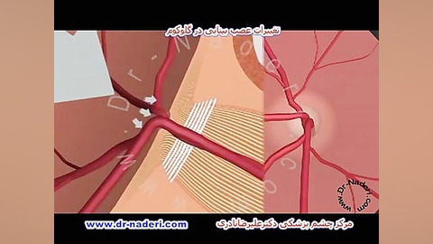 تغییرات عصب بینایی در گلوکوم -سایت چشم پزشکی دکتر نادری دندانپزشکی کودکان