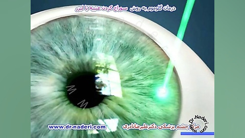 درمان گلوکوم بالیزرایریدوتومی -مرکز چشم پزشکی دکترنادری مرکز چشم پزشکی دکتر علیرضا نادری www.dr-naderi.com