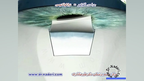 جراحی گلوکوم یا ترابکولکتومی - مرکز چشم پزشکی دکترنادری مرکز چشم پزشکی دکتر علیرضا نادری www.dr-naderi.com