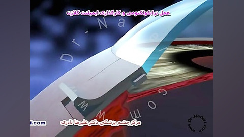 جراحی کارگذاری ایمپلنت گلوکوم-مرکز چشم پزشکی دکترنادری مرکز چشم پزشکی دکتر علیرضا نادری www.dr-naderi.com