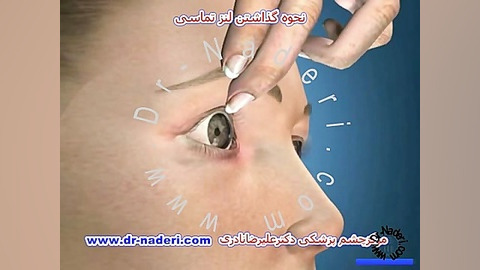 نحوه گذاشتن لنز تماسی- مرکز چشم پزشکی دکتر علیرضا نادری مرکز چشم پزشکی دکتر علیرضا نادری www.dr-naderi.com