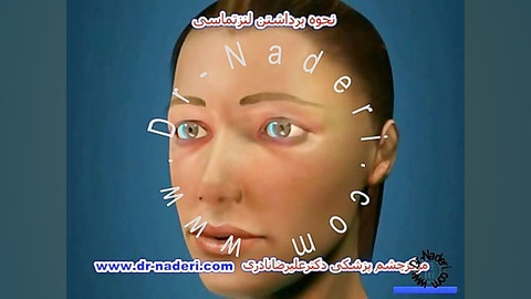 نحوه برداشتن لنزتماسی- مرکز چشم پزشکی دکتر علیرضا نادری مرکز چشم پزشکی دکتر علیرضا نادری www.dr-naderi.com