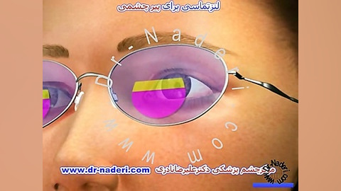 لنز تماسی پیرچشمی - مرکز چشم پزشکی دکتر علیرضا نادری مرکز چشم پزشکی دکتر علیرضا نادری www.dr-naderi.com