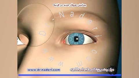پیدایش عروق در قرنیه -مرکز چشم پزشکی دکتر علیرضا نادری کشیدن دندان