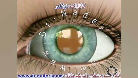 کاتاراکت نوکلئار - سایت چشم پزشکی دکتر علیرضا ناد ری پلاسماجت