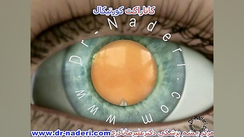 کاتاراکت کورتیکال - سایت چشم پزشکی دکتر علیرضا ناد ری لیزر مو