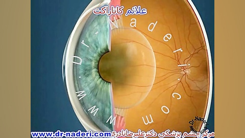 علائم کاتاراکت -سایت چشم پزشکی دکتر علیرضا ناد ری مرکز چشم پزشکی دکتر علیرضا نادری www.dr-naderi.com