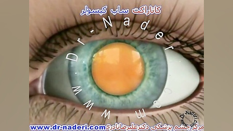 کاتاراکت ساب کپسولار -سایت چشم پزشکی دکتر علیرضا ناد ری مرکز چشم پزشکی دکتر علیرضا نادری www.dr-naderi.com