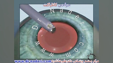 درمان کاتاراکت -سایت چشم پزشکی دکتر علیرضا ناد ری مرکز چشم پزشکی دکتر علیرضا نادری www.dr-naderi.com