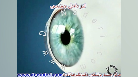 لنز های داخل چشمی - مرکز چشم پزشکی دکتر علیرضا نادری مرکز چشم پزشکی دکتر علیرضا نادری www.dr-naderi.com