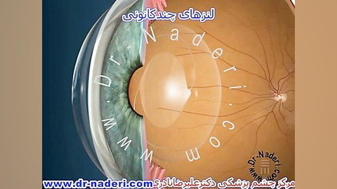لنز داخل چشمی چند کانونی - مرکز چشم پزشکی دکتر نادری مرکز چشم پزشکی دکتر علیرضا نادری www.dr-naderi.com