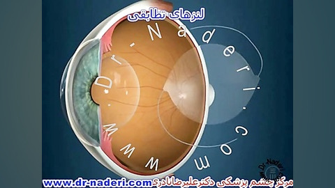 لنز داخل چشمی تطابقی - مرکز چشم پزشکی دکتر نادری مرکز چشم پزشکی دکتر علیرضا نادری www.dr-naderi.com