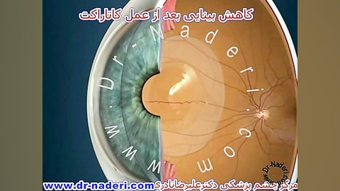 لیزر کپسولوتومی بعداز کاتاراکت-مرکز چشم پزشکی دکترنادری مرکز چشم پزشکی دکتر علیرضا نادری www.dr-naderi.com