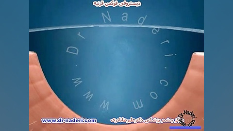 دیستروفی فوکس قرنیه -مرکز چشم پزشکی دکتر علیرضا نادری مرکز چشم پزشکی دکتر علیرضا نادری www.dr-naderi.com