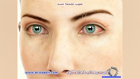 عفونت ملتحمه یا کنژنکتیویت - مرکز چشم پزشکی دکتر نادری مرکز چشم پزشکی دکتر علیرضا نادری www.dr-naderi.com