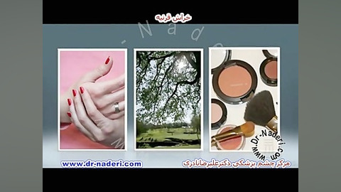 خراش عود کننده قرنیه- مرکزچشم پزشکی دکتر علیرضا نادری مرکز چشم پزشکی دکتر علیرضا نادری www.dr-naderi.com