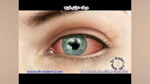 درمان خراش عودکننده قرنیه-مرکزچشم پزشکی دکترعلیرضانادری مرکز چشم پزشکی دکتر علیرضا نادری www.dr-naderi.com