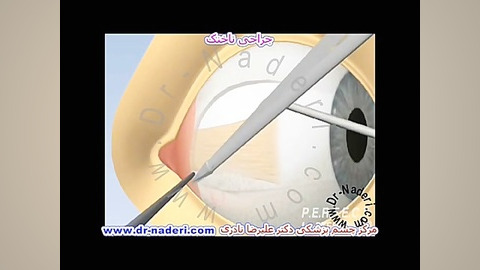 جراحی ناخنک - مرکز چشم پزشکی دکتر علیرضا نادری مرکز چشم پزشکی دکتر علیرضا نادری www.dr-naderi.com