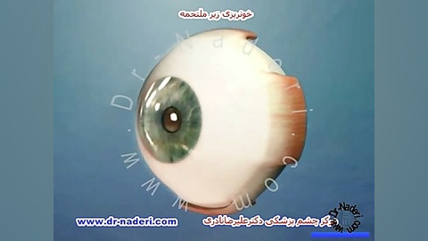 خونریزی زیر ملتحمه چشم-مرکز چشم پزشکی دکتر علیرضا نادری مرکز چشم پزشکی دکتر علیرضا نادری www.dr-naderi.com