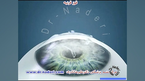 پیوند تمام ضخامت قرنیه-مرکز چشم پزشکی دکتر علیرضا نادری مرکز چشم پزشکی دکتر علیرضا نادری www.dr-naderi.com