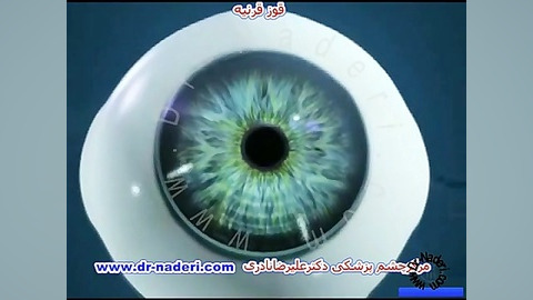 قوز قرنیه چیست؟ -مرکز چشم پزشکی دکتر علیرضا نادری مرکز چشم پزشکی دکتر علیرضا نادری www.dr-naderi.com