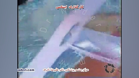 رینگ داخل قرنیه INTACS-سایت چشم پزشکی دکترعلیرضا ناد ری مرکز چشم پزشکی دکتر علیرضا نادری www.dr-naderi.com