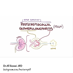 بیماری گلومرولونفریت قسمت پنجم...